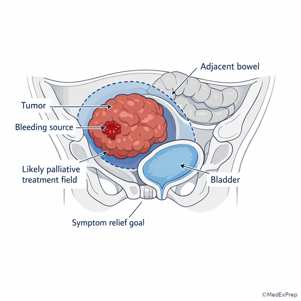 Bleeding pelvic tumor and palliative field concept